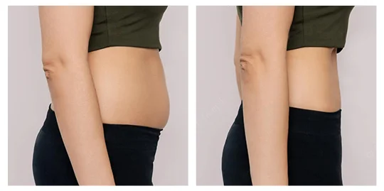Kryolipolýza pred a po - boky