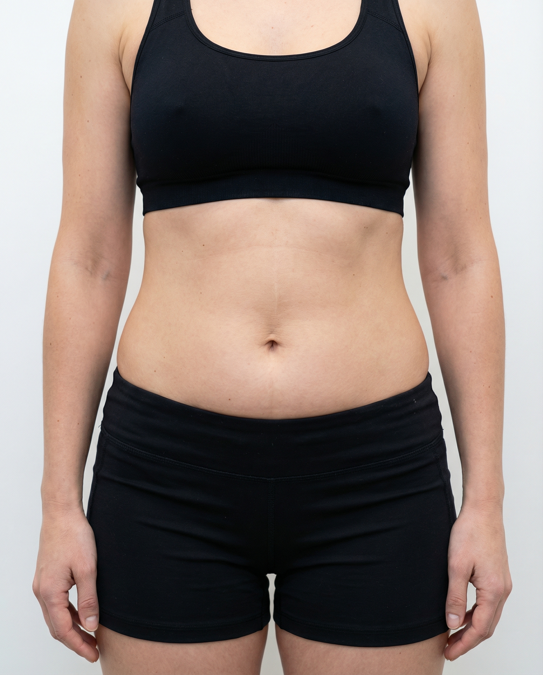 Po EMSlim ošetrení - brucho