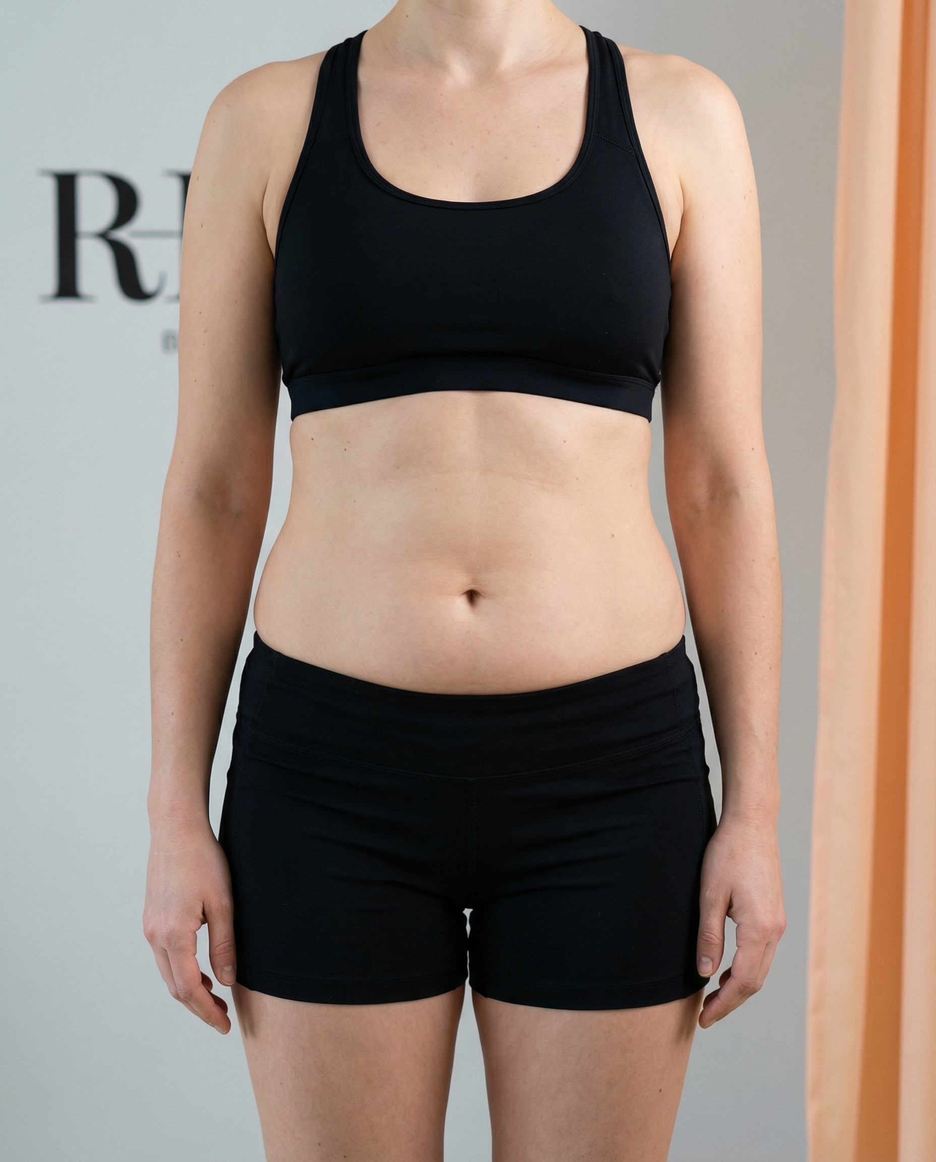 Pred EMSlim ošetrením - brucho